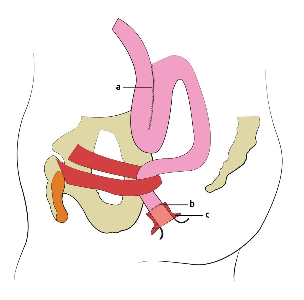 Yücesoy and Güleç: Ileal U Pouch Reconstruction Proximal To Straight Sublevator Ileo 7 Figure 3: Illustration of the ileal U pouch and the straight sublevator straight ileoanal anastomosis.