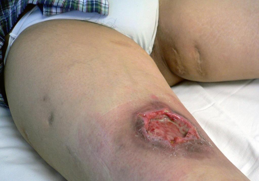 Cutaneous NK cell lymphoma and