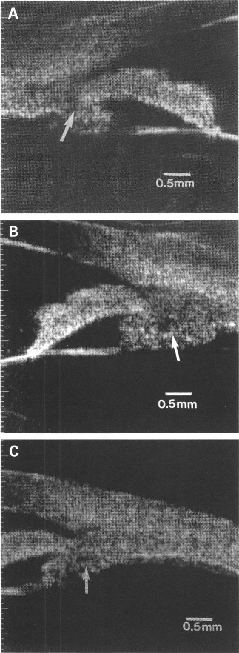 Ciliary body enlargement and cyst formation in uveitis 897 Three new ciliary body cysts formed (that is, cysts in areas in which they were not previously detected) in three (27%) uveitic eyes during