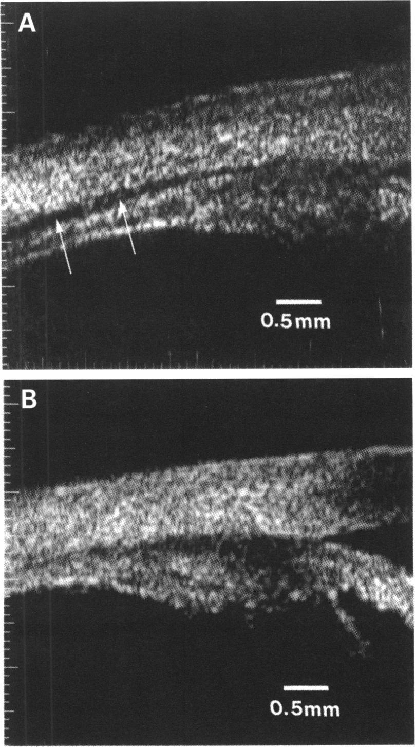 898 Gentile, Liebmann, Tello, Stegman, Weissman, Ritch Figure 2 (A) Sagital view of massive enlargement of the ciliary body (arrows) involving the pars plana (P) with associated hyphaema (H) in the