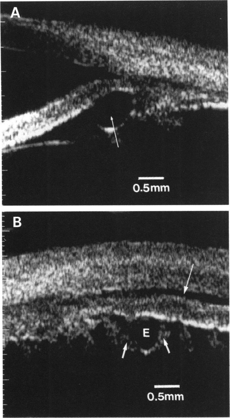 Ciliary body enlargement and cystformation in uveitis Figure 4 (A) Typical cyst (arrow) at the iridociliary junction. (B) Cyst (E) in transverse section among the ciliary processes (small arrows).