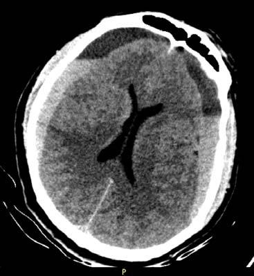 400 Adam et al - Anton-Babinski syndrome in chronic bilateral subdural hematomas difficult and seemed to present no motor or cranial nerve deficits at the time.