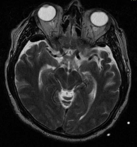 Emergency head CT scan revealed chronic bilateral subdural hematomas (separated type according to the Nakaguchi classification1) with a maximal thickness of 1,6 cm on the left side and 1,3 cm on the