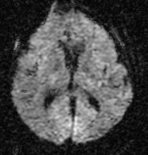 Ophthalmological examination revealed no abnormalities and raised the suspicion of cortical blindness. Emergency MRI performed on the first postoperative day revealed no ischemic lesions (Figure 2).