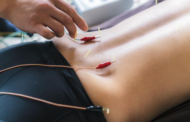 It s Official: Acupuncture Doctor Approved 04 MARCH 2017 The American College of Physicians formally recommends acupuncture for the treatment of back pain.