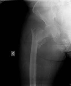 INTRODUCTION Trochanteric (pertrochanteric/ intertrochanteric) fractures account for almost 40% of all proximal femoral fractures (1).