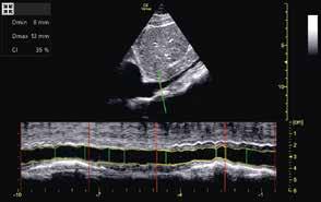 The Auto VTI tool helps you assess flow through the left ventricular outflow tract. And the Auto IVC tool helps make assessment of the IVC collapsibility surprisingly simple.