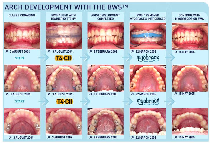 Further Anterior Alignment The BWS and TRAINER System usually achieve good dental alignment but often further aligning of the anterior teeth is