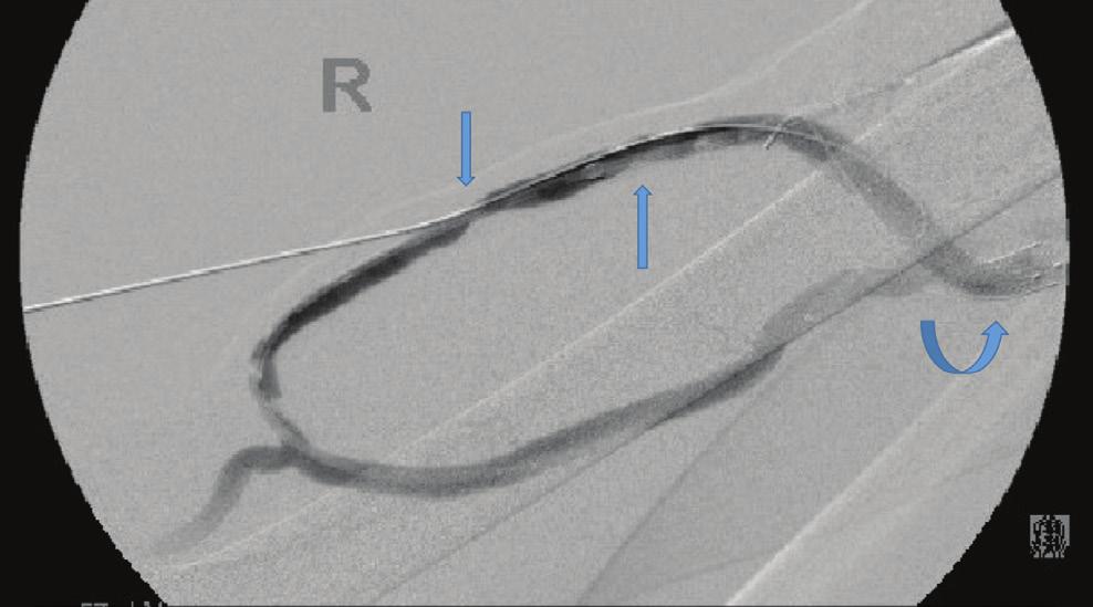 Figure 3. The residual stenosis noted at the venous anastomosis was ultimately stented with an 8 mm x 5 cm GORE VIABAHN Endoprosthesis. Arrows indicate deployed stent graft. Figure 4.