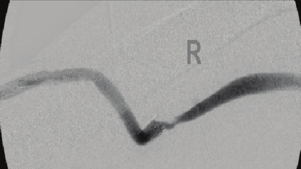 Residual thrombus remained within the graft. The previously placed 8 mm x 5 cm GORE VIABAHN Endoprosthesis at the venous anastomosis is indicated with a curved arrow.
