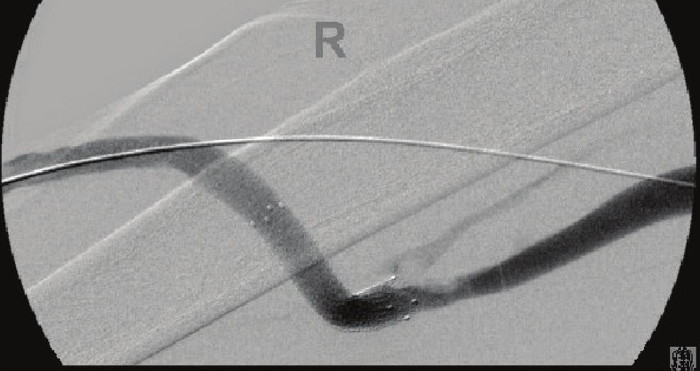 Figure 7. The accessory vein was once again noted at the site of recurrent venous anastomotic stenosis following the declotting procedure. This accessory vein was present on the initial examination.