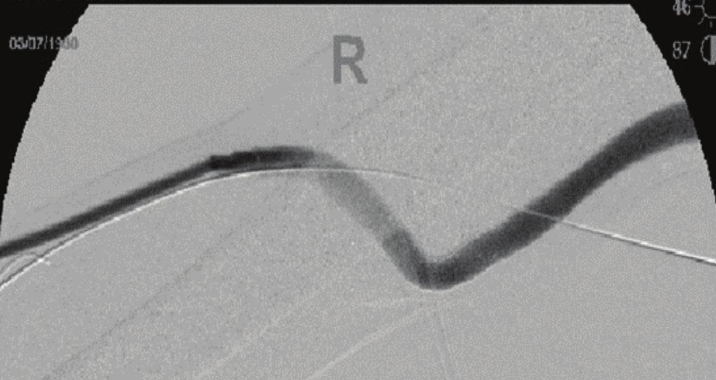 After placement of a 9 mm x 5 cm GORE VIABAHN Endoprosthesis with the previously placed stent and extending into the draining right axillary vein, prompt flow was reestablished through the patient s