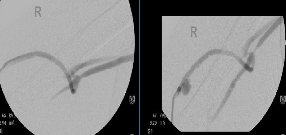 The GORE REVISE clinical trial showed that when treating a patient with a venous anastomotic stenosis and with no prior intervention, there was only a small percentage difference between percutaneous