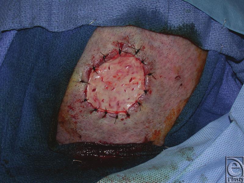 eplasty VOLUME 11 Figure 2. Acellular dermal matrix inset intraoperatively after burring of the outer table.