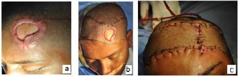 Fig. 1: Bilateral advancement flap for