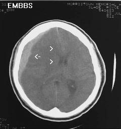 Acute Subdural Hematoma Another example of acute