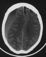 Subacute Subdural Hematoma Noncontrast CT note the