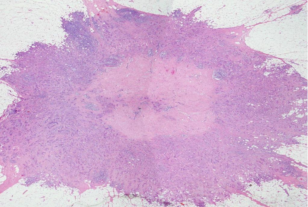 Pathology after Neoadjuvant Letrozole Central Scar Central scarring seen in 60% with