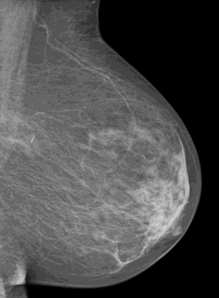 Mammographic Response