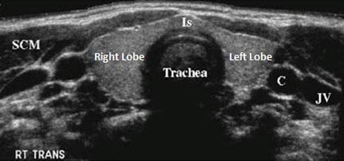 Figure 2-4: Sonographic appearance of normal thyroid gland in transverse section (Is isthmus, C carotid artery, JV jugular vine, SCM sternocleidomastoid muscle). (www.chop.