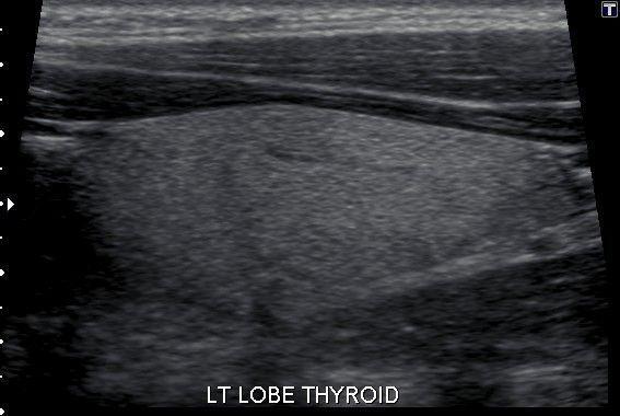 com) (23) 2-5 Thyroid pathology and sonogrphic appearances : Ultrasound is used to determine the solid or cystic nature of a cold nodule but it is unable to differentiate benign from malignant