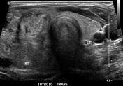 Figure 2-6: Ultrasound image of Multi nodular Goiter. (www.radiopaedia.