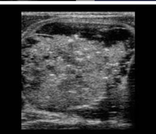 Figure 2-9: Papillary thyroid carcinoma with calcification longitudinal image. (www.ultrasoundcase.info.