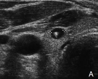 2-5-4-2 Simple cysts: Are rare. Most thyroid cysts are complex and represent degeneration of either an adenoma or a colloid nodule.