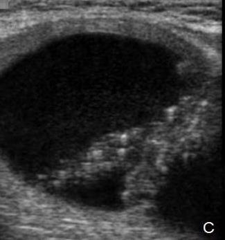 Fluid in a thyroid nodule is most consistent with a degenerating adenoma however malignancy cannot be excluded. (Gilani S.