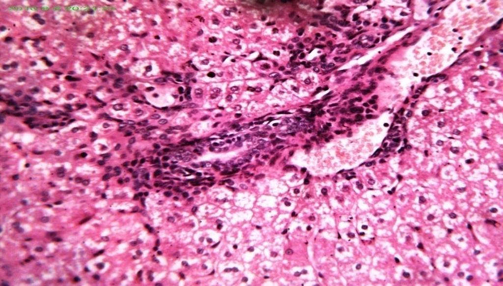 The portal area showed congestion in the portal vein, inflammatory cells infiltration (B) (H&E X400). C A B Figure (4.
