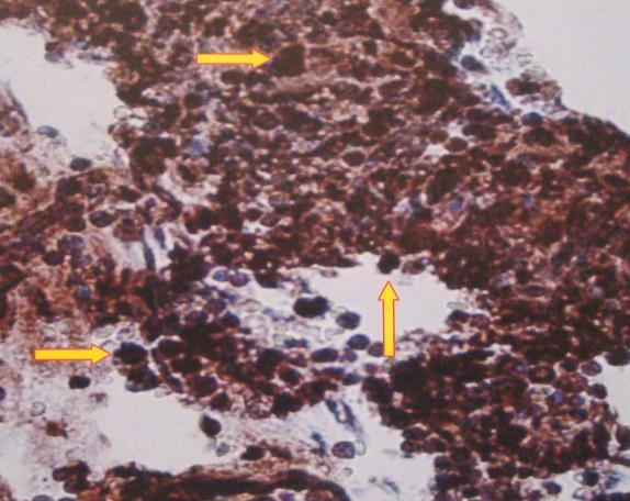 1,3). Figure 1: bone marrow tissue of CLL stained with VEGF most of cells show brown membrane and cytoplasmic stain (VEGF positive) (X40).