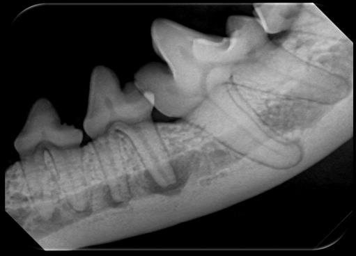 ! Radiographic Signs of Endodontic Disease Periapical lucency Increased width of the apical PDL space