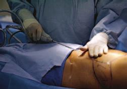 Liposuction Aesthetic