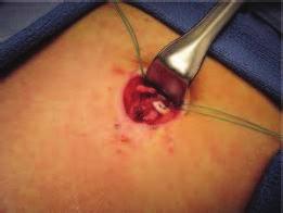implant: (implantable