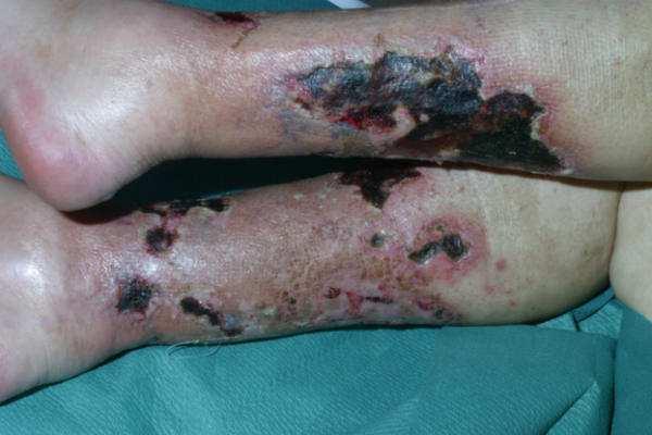 Calciphylaxis lesions on the legs Pliquett RU,