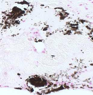 Calciphylaxis: Skin biopsy (calcium stain) Extensive deposition of calcium in the