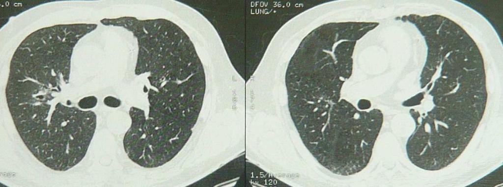 FINDINGS Chest X-ray: nodules CT Scan of sinus CT