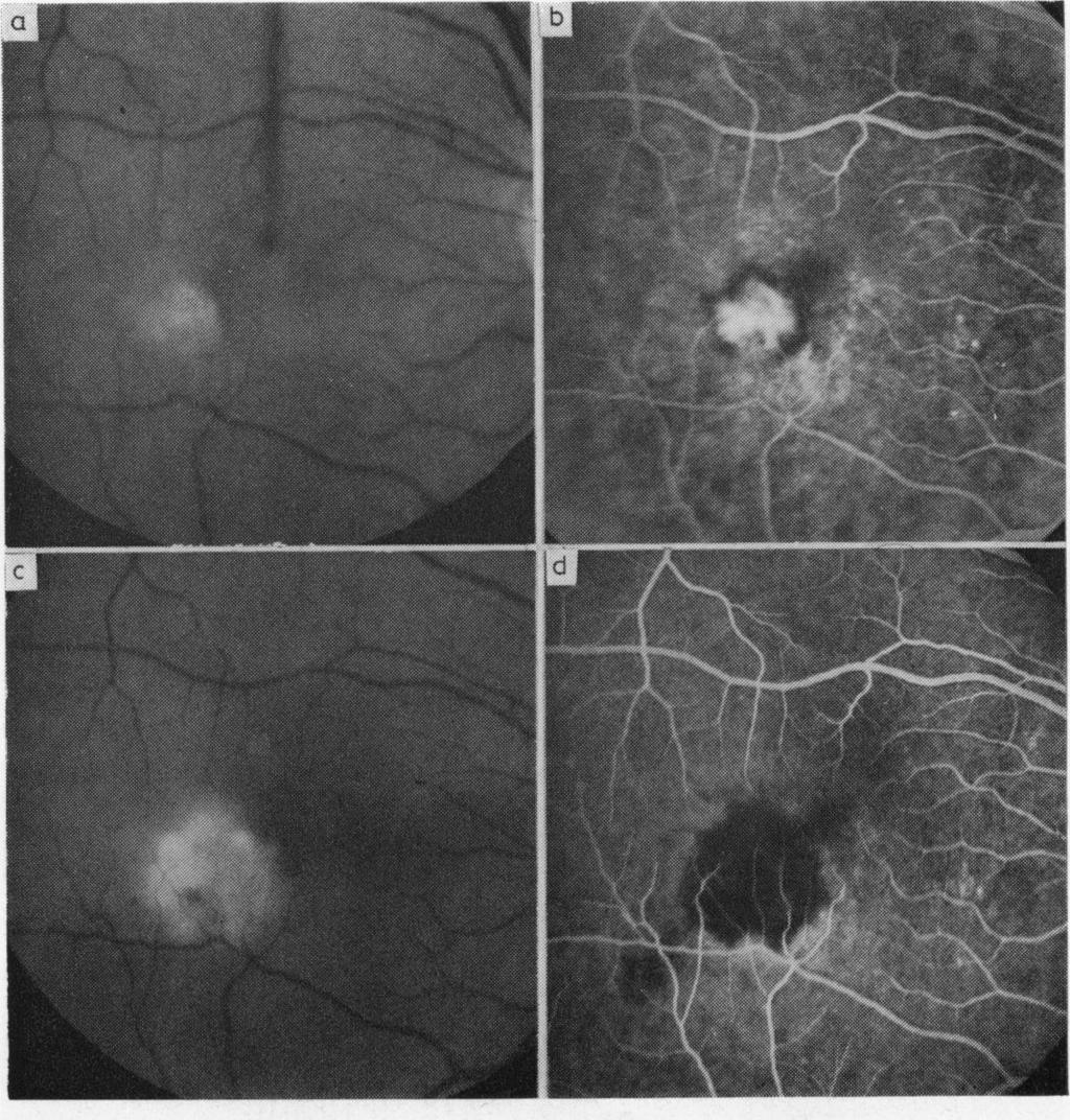 Photocoagulation of disciform macular lesions with krypton laser Fig. 2 Case 8.