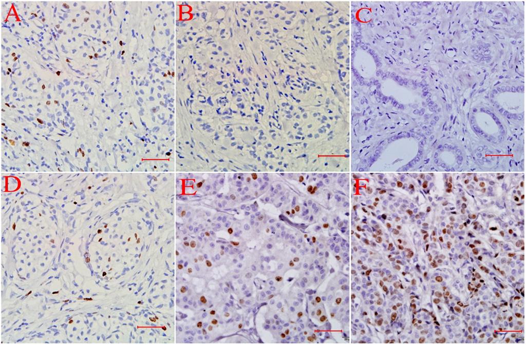 Xue-Qin Yang et al Table 1. The Main Clinicopathological Features and Ki-67 Expression (n=13) Items Total N (%) Figure 1.