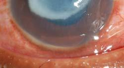40) Time to re epithelialization (p=0.44) Corneal perforation (p>0.