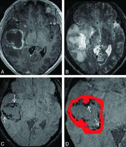 A 57-year-old man with a right temporal necrotic glioblastoma. Toh C et al.