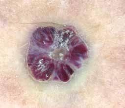 PHOTO COURTESY OF: ASHFAQ MARGHOOB, MD FIGURE 7 Angiokeratoma This dermoscopy of an angiokeratoma shows dark purple lacunae, whitish septae, and some keratinization.