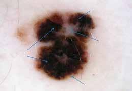 atypical globules, off-centered blotches, a scar-like area, and streaks. Streaks Scar-like area (regression structure) 4.