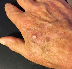 1 Squamous cell skin cancer basics Diagnosing SCC Genetic syndromes If you have certain genetic syndromes, it means you are at higher risk of getting SCC.