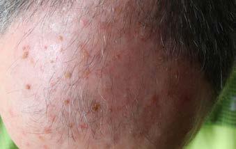 Another is xeroderma pigmentosum, in which the body isn t able to repair damage to DNA (deoxyribonucleic acid) caused by sunlight.
