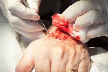 In standard surgery (see below), it is not known until 2 7 days later (after testing with another doctor called a pathologist) whether there are cancer cells at the edges of tissue that was removed.