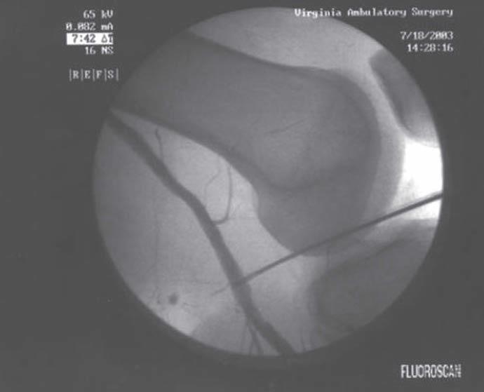 misfire Iatrogenic meniscus damage larger diameter holes within meniscus Repairs