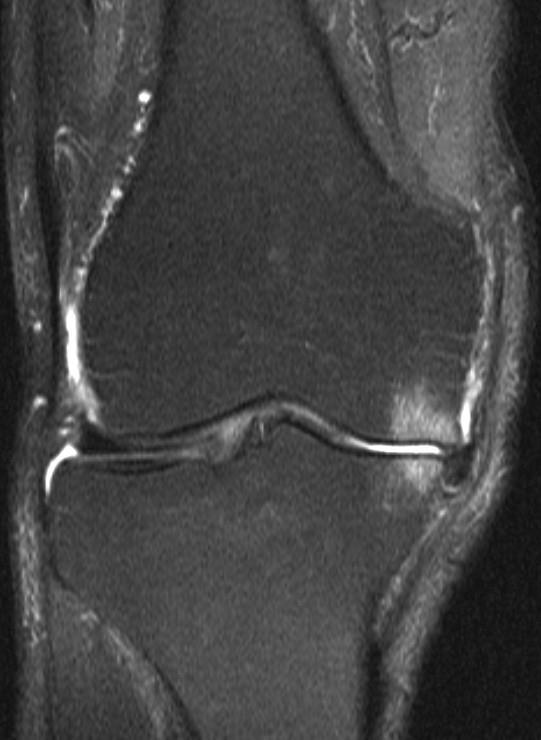 ) Horizontal tear Complexity of tearing Radial tears Meniscal Root