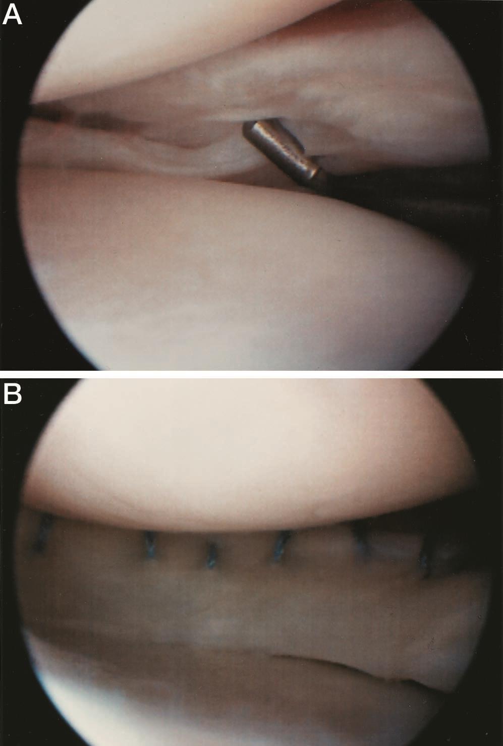 Inside-Out Method Arthroscopic Repair meniscal Tears Extending into the Avascular Zone in Patients Younger Than Twenty Years of Age Noyes AJSM 2002