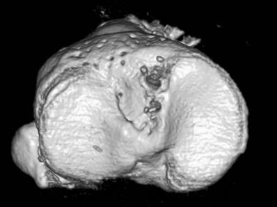 HT Typical tunnel position (3D CT) Anatomical double-bundle Taketomi et al.